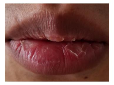 剥脱性口唇炎の症状